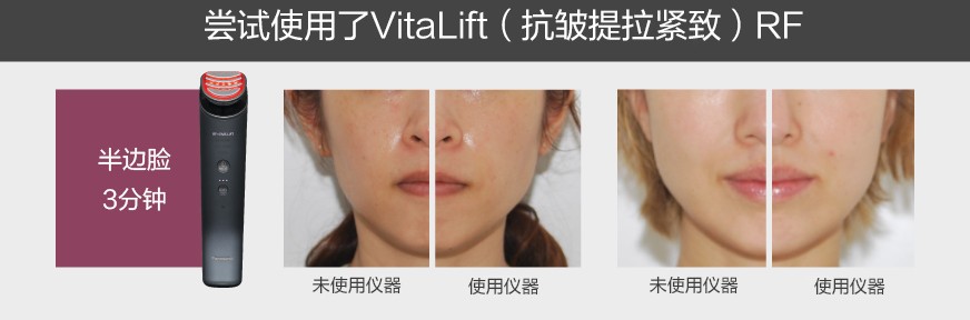 嘗試使用了VitaLift（抗皺提拉緊致）RF