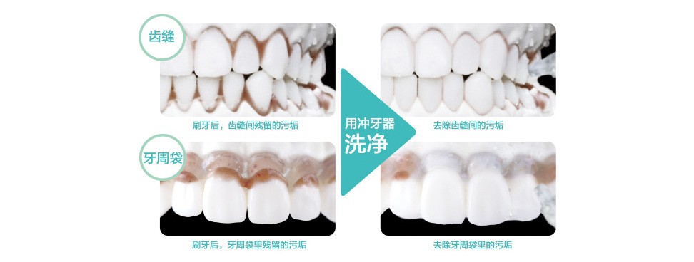 刷牙后，用水流沖洗，呵護齒縫及牙周袋